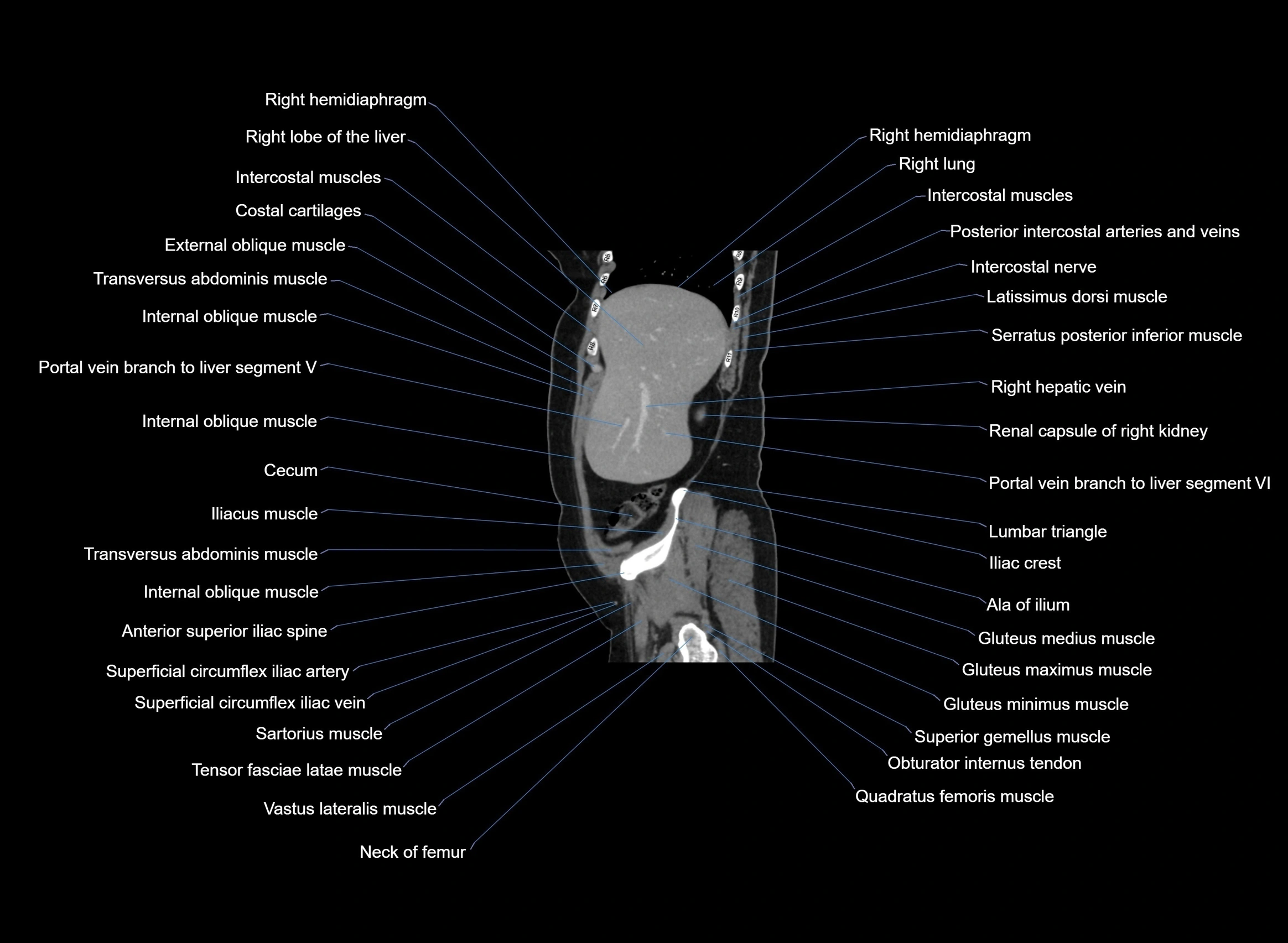 CT Abdomen sagittal cross sectional anatomy labelled radiology image -00093.webp